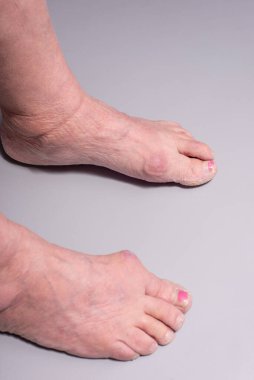 Gri arka planda yaşlı bir kadının ayak hastalıkları..
