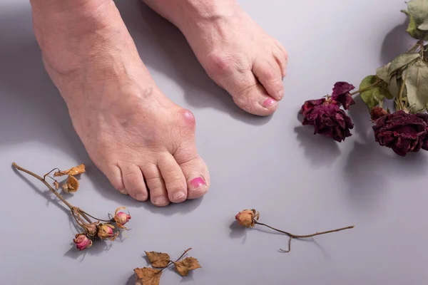 foot disease concept of dry flowers at feet of old woman on gray background