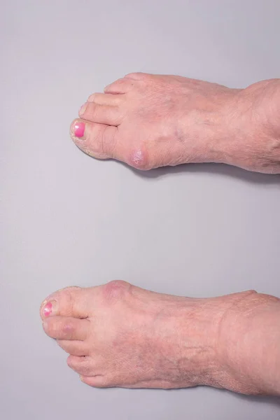 close-up of big toe disease curvature in elderly woman on gray background.