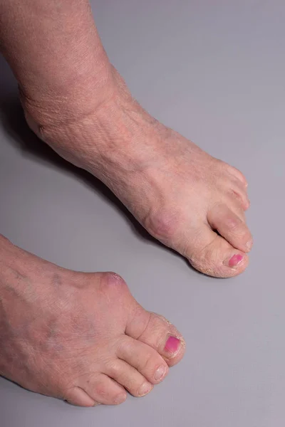 close-up of big toe disease curvature in elderly woman on gray background.