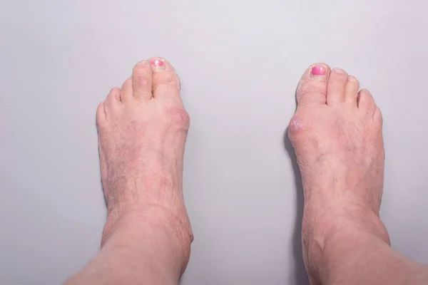 close-up of big toe disease curvature in elderly woman on gray background.