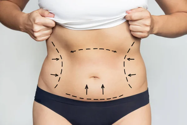 Großaufnahme Des Bauches Einer Frau Mit Überschüssigem Fett Mit Markierung — Stockfoto
