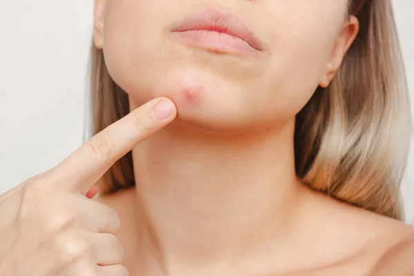 Mulher Apontando Conceito Tratamento Beleza Acne — Fotografia de Stock