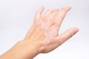 cropped image of female hand with peeling off skin