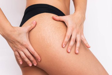 closeup of stretching's marks on legs