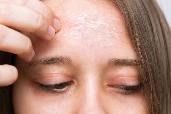 Close Woman Peeling Forehead — Stock Photo, Image