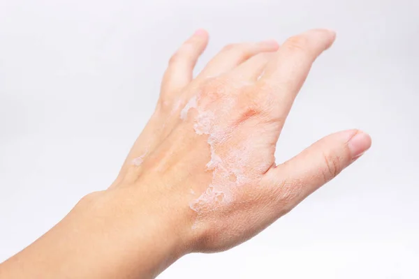 Cropped Image Female Hand Peeling Skin — стоковое фото