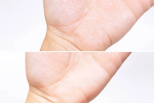 Cropped Image Female Hand Peeling Skin — 스톡 사진