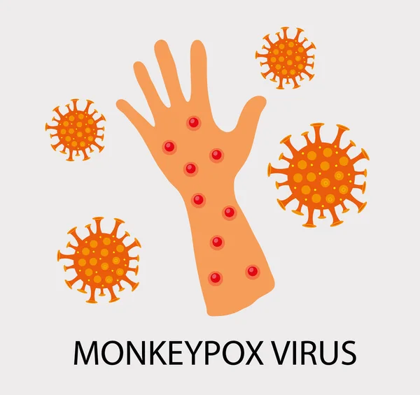 Wirus ospy małpiej zoonotyczna choroba wirusowa, która może zainfekować ludzi, zwierząt naczelnych. Małpia ospa. Ilustracja wektora — Wektor stockowy