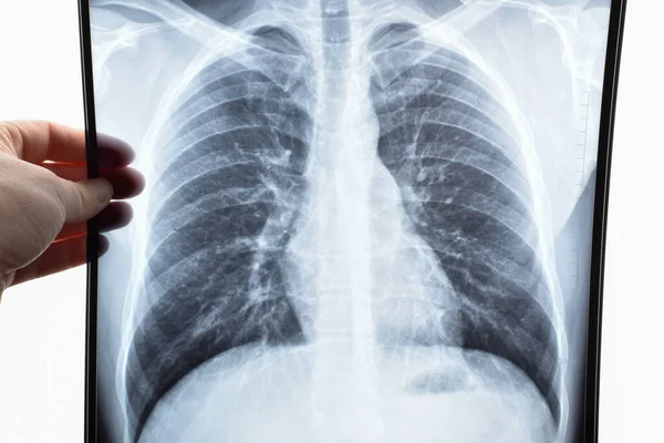 Lung X-ray. Check for coronavirus or cancer. A snapshot of organs in the hands of a doctor. Fluorography Photos De Stock Libres De Droits