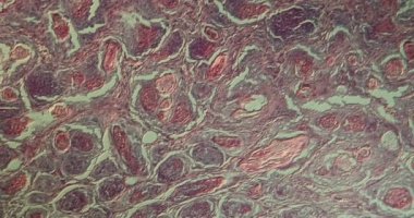 Spinalioma, mikroskop altında hastalıklı doku.