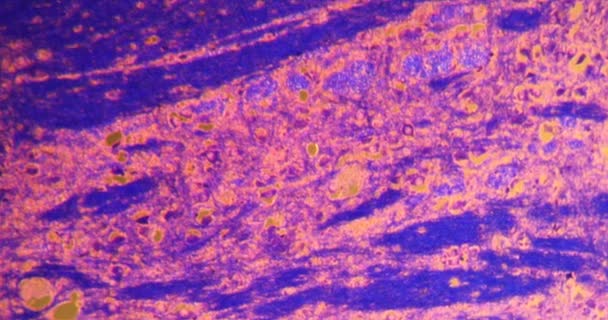Alcoholabuse Brain Darkfield Tissue Microscope 100X — Stock Video