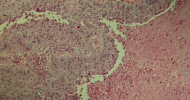 Ciğerlerdeki squamous hücre kanseri mikroskop altında 100 kat büyümüş.