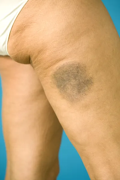 Hematoma — Fotografia de Stock