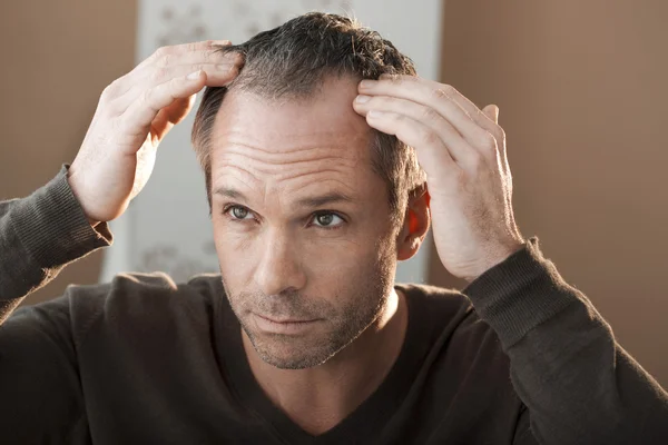Alopeci Stockfoto