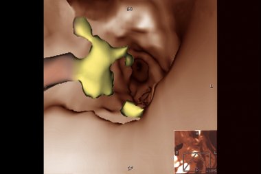 Atheroma plaques at the origin of the right vertebra clipart
