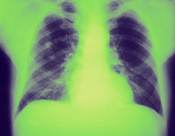 Stock image Revealed right upper lobe pneumonia