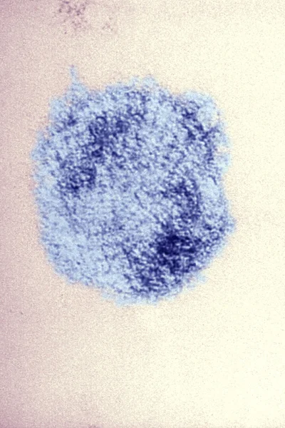 汉坦病毒肺综合征 — 图库照片