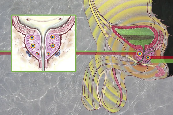 Illustrazione dell'adenoma — Foto Stock