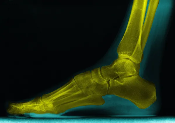 踝关节 x 射线 — 图库照片