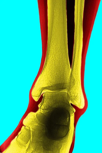 Radiografía de la tibia —  Fotos de Stock