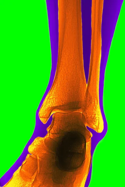 X-ray van het scheenbeen — Stockfoto