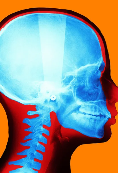 Radiografía del cráneo — Foto de Stock