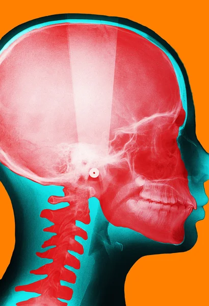 X-ışını kafatası — Stok fotoğraf