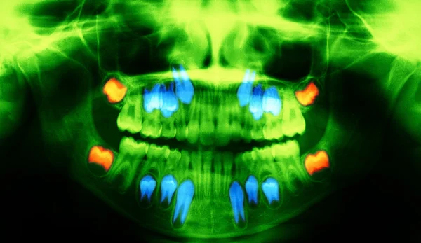 치과 엑스레이 — 스톡 사진