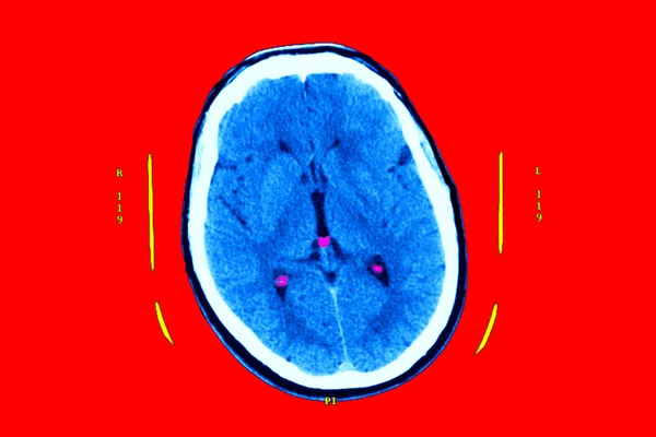 Hyper flash in the two nuclei — Stock Photo, Image