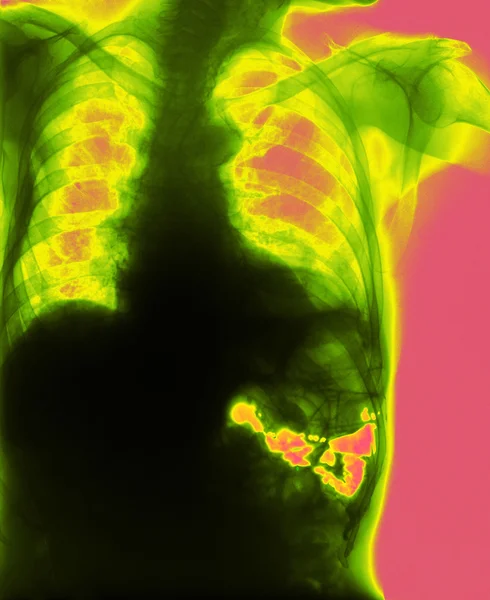 Diaphragmatic hernia — Stock Photo, Image