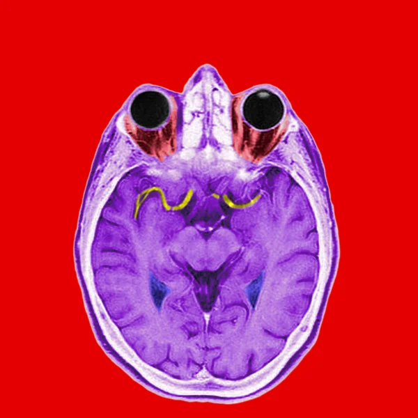 Anterior and medial cerebral arteries — Stock Photo, Image