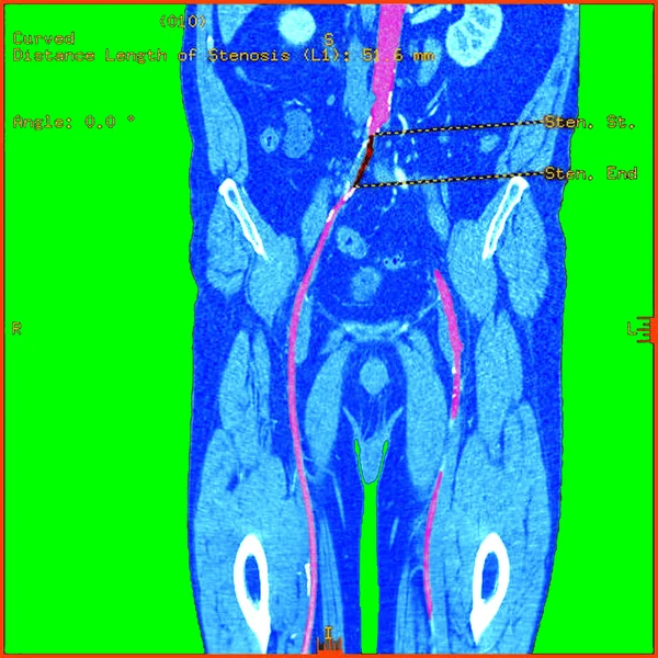 Abdominal aorta — Stock Photo, Image