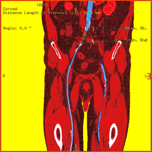Sténose de l'aorte abdominale — Photo