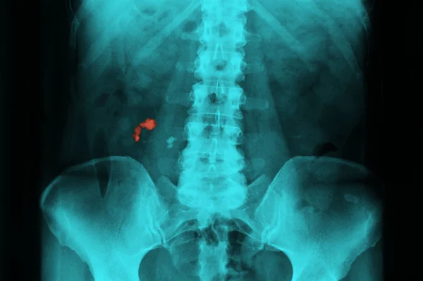 Kidney lithiasis — Stock Photo, Image