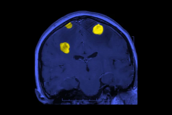 Cáncer cerebral — Foto de Stock