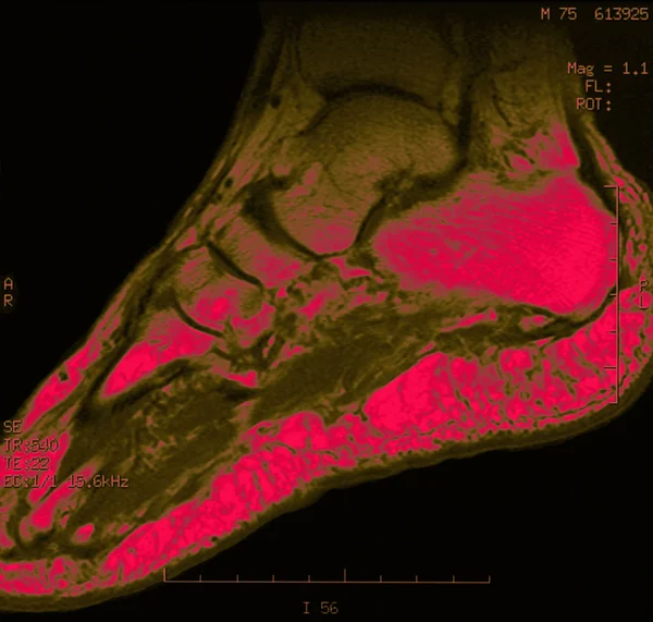 Menselijke voet x-ray — Stockfoto
