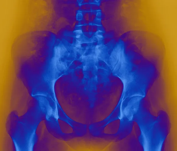 Thigh bone — Stock Photo, Image