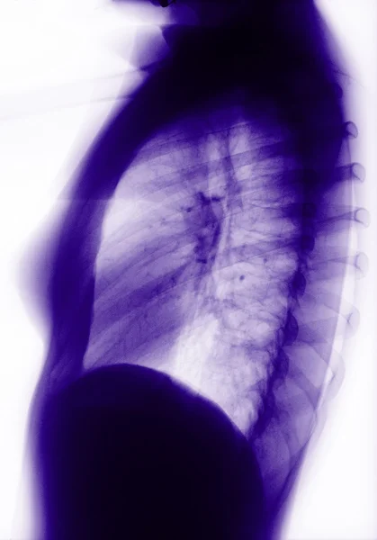 Human thorax — Stock Photo, Image