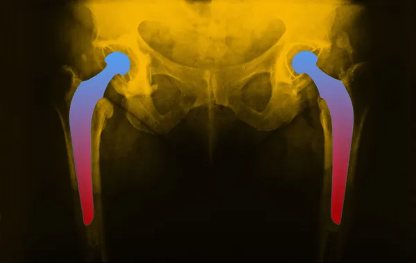 Man's hip radiograph — Stock Photo, Image