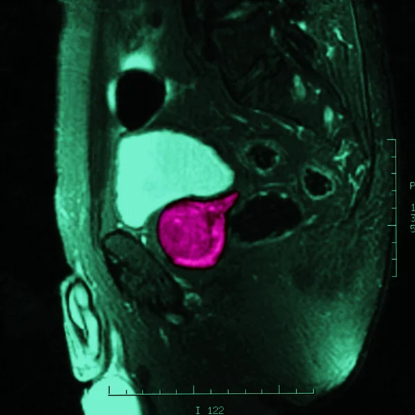 Tumor Röntgen — Stockfoto