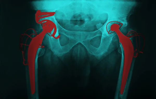 Man's hip radiograph — Stock Photo, Image