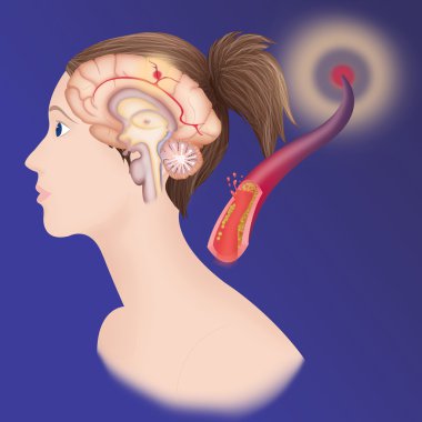 Depiction of an ischemic stroke clipart