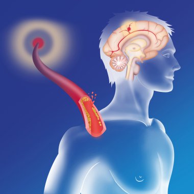 Depiction of an ischemic stroke clipart