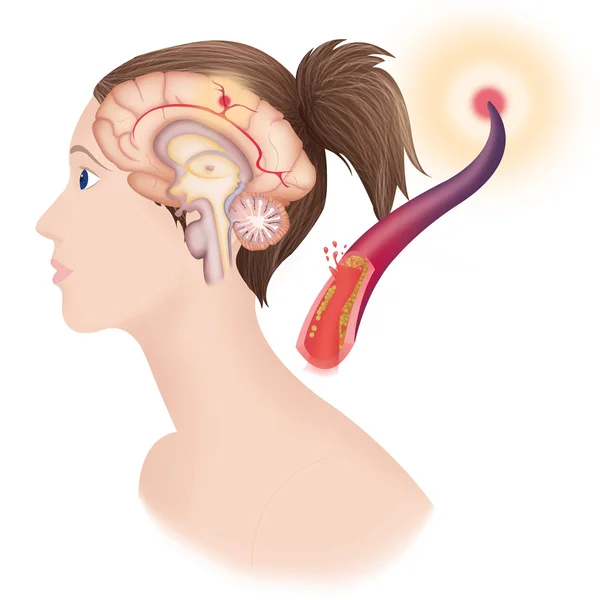 Depiction of an ischemic stroke — Stock Photo, Image