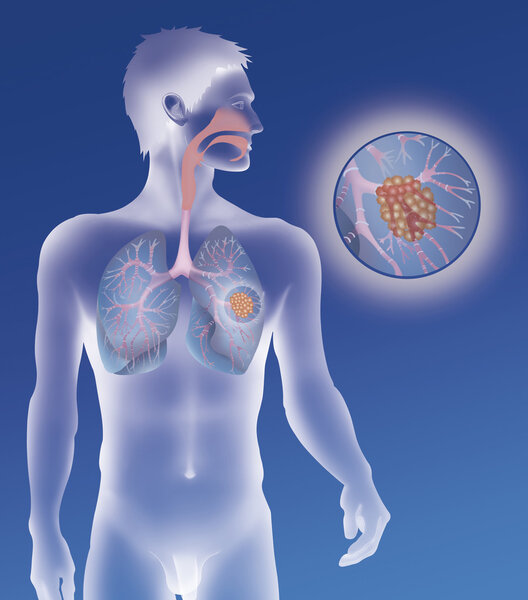 Изображение раковой опухоли
