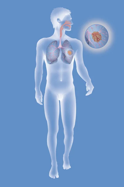 Representación de un tumor canceroso —  Fotos de Stock