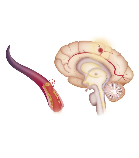 Depiction of an ischemic stroke — Stock Photo, Image
