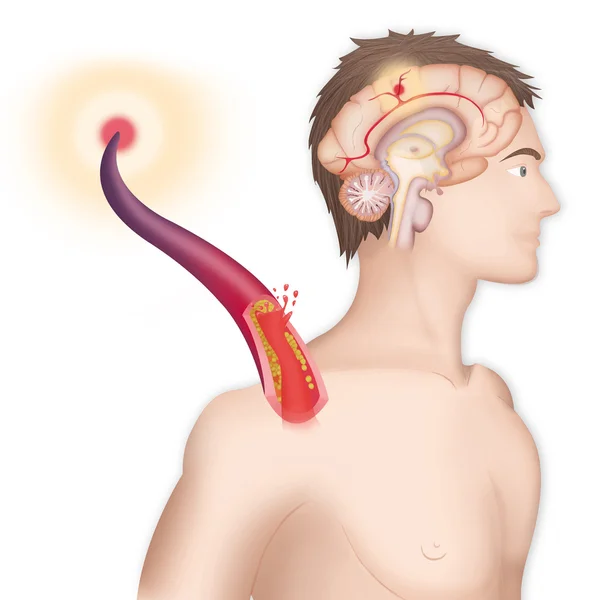 Representación de un ictus isquémico — Foto de Stock