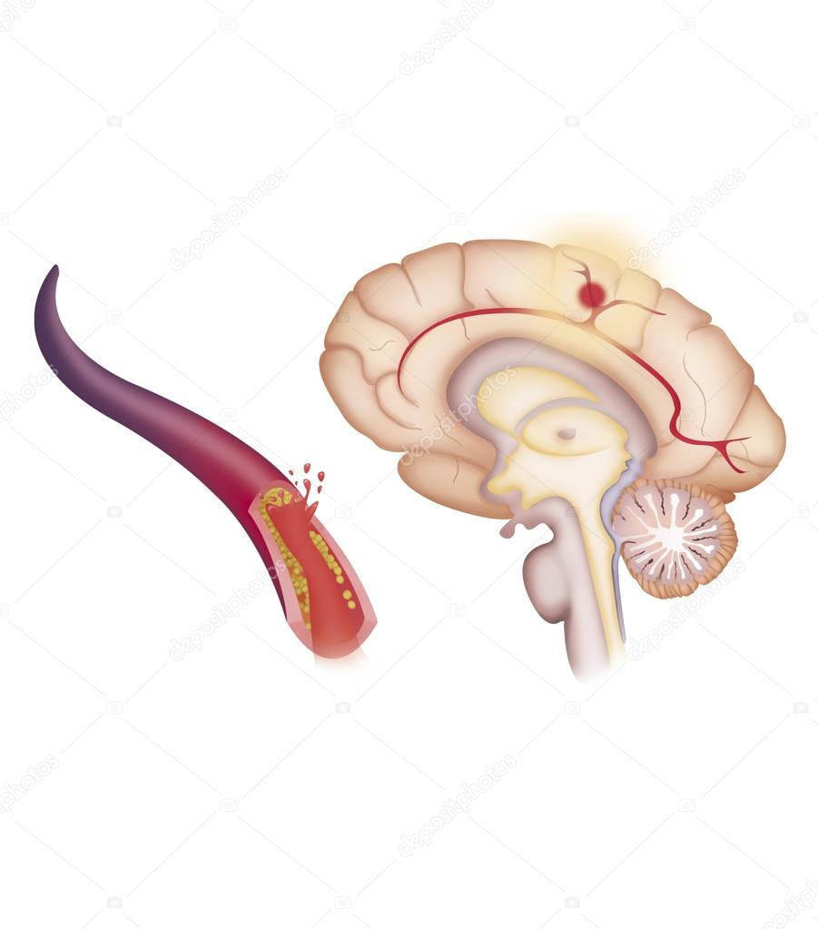 Depiction of an ischemic stroke